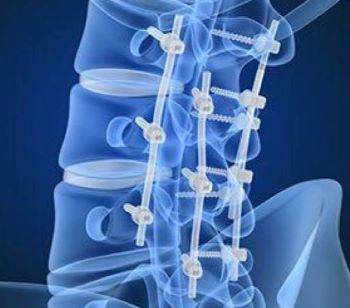 Spinal Fixation Spinal fixation