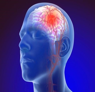 Brain aneurysm brain aneurysm